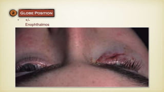 • +/-
Enophthalmos
 