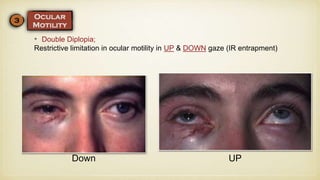 • Double Diplopia;
Restrictive limitation in ocular motility in UP & DOWN gaze (IR entrapment)
UPDown
 