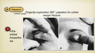 Orbital margin
Fingertip exploration 360°; palpation for orbital
margin fracture.
• Infra-
orbital
Anaesthe
sia
 
