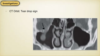 • CT Orbit: Tear drop sign
 