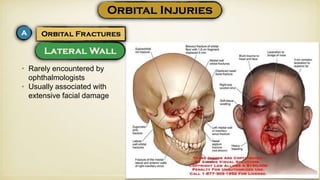 • Rarely encountered by
ophthalmologists
• Usually associated with
extensive facial damage
 