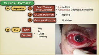 • Lid oedema
• Conjunctiva Chemosis, hematoma
• Proptosis
• Limitation
• Hig
h
• ONH
swelling
 