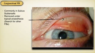 • Commonly in Sulcus
Subtarsalis
• Removed under
topical anaesthesia
(Search for other
FBs)
 
