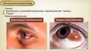 • Causes:
A. Spontaneous; uncontrolled hypertension, bleeding disorder, Valsalva
B. Trauma
• Resolve spontaneously
 
