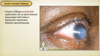 • Focal or Diffuse endothelial
dysfunction 2ry to blunt trauma
• Associated with folds in
Descemet membrane
• Resolve spontaneously
 