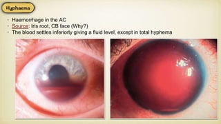 • Haemorrhage in the AC
• Source: Iris root, CB face (Why?)
• The blood settles inferiorly giving a fluid level, except in total hyphema
 