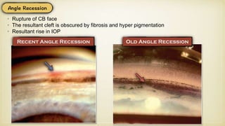 • Rupture of CB face
• The resultant cleft is obscured by fibrosis and hyper pigmentation
• Resultant rise in IOP
 