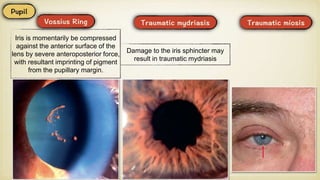 Iris is momentarily be compressed
against the anterior surface of the
lens by severe anteroposterior force,
with resultant imprinting of pigment
from the pupillary margin.
Damage to the iris sphincter may
result in traumatic mydriasis
 
