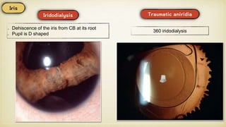 Dehiscence of the iris from CB at its root
Pupil is D shaped
360 iridodialysis
 