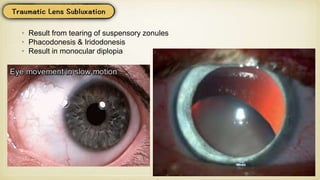 • Result from tearing of suspensory zonules
• Phacodonesis & Iridodonesis
• Result in monocular diplopia
 