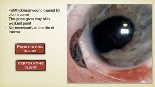 • Full thickness wound caused by
blunt trauma
• The globe gives way at its
weakest point
• Not necessarily at the site of
trauma
 