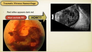 • Red reflex appears dark red
HOW??
 