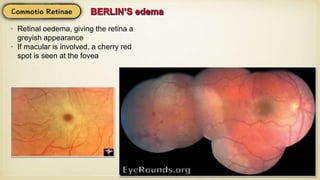 • Retinal oedema, giving the retina a
greyish appearance
• If macular is involved, a cherry red
spot is seen at the fovea
 