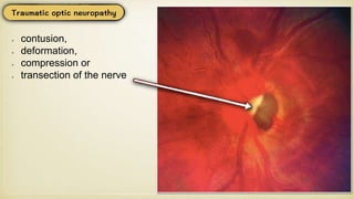 contusion,
deformation,
compression or
transection of the nerve
 