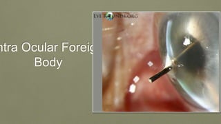 ntra Ocular Foreign
Body
 