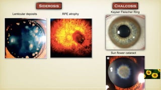 Lenticular deposits RPE atrophy
Kayser Fleischer Ring
Sun flower cataract
 
