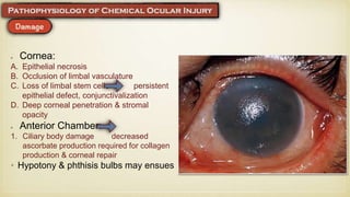 Cornea:
A. Epithelial necrosis
B. Occlusion of limbal vasculature
C. Loss of limbal stem cells persistent
epithelial defect, conjunctivalization
D. Deep corneal penetration & stromal
opacity
Anterior Chamber:
1. Ciliary body damage decreased
ascorbate production required for collagen
production & corneal repair
• Hypotony & phthisis bulbs may ensues
 