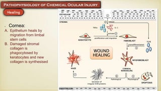 Cornea:
A. Epithelium heals by
migration from limbal
stem cells
B. Damaged stromal
collagen is
phagocytosed by
keratocytes and new
collagen is synthesised
 