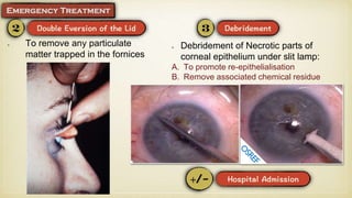 To remove any particulate
matter trapped in the fornices
Debridement of Necrotic parts of
corneal epithelium under slit lamp:
A. To promote re-epithelialisation
B. Remove associated chemical residue
 