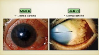 < 1/3 limbal ischemia > 1/2 limbal ischemia
 