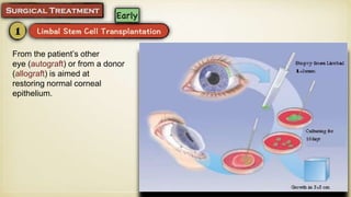 From the patient’s other
eye (autograft) or from a donor
(allograft) is aimed at
restoring normal corneal
epithelium.
 