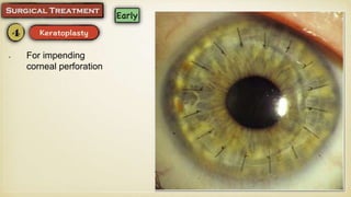 For impending
corneal perforation
 