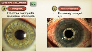For corneal scarring after
resolution of inflammation
For severely damaged
eye
 