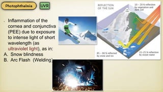 Inflammation of the
cornea and conjunctiva
(PEE) due to exposure
to intense light of short
wavelength (as
ultraviolet light), as in:
A. Snow blindness
B. Arc Flash (Welding)
 