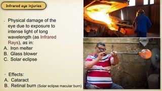 Physical damage of the
eye due to exposure to
intense light of long
wavelength (as Infrared
Rays), as in:
A. Iron melter
B. Glass blower
C. Solar eclipse
• Effects:
A. Cataract
B. Retinal burn (Solar eclipse macular burn)
 