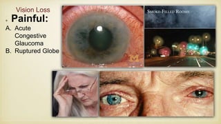Painful:
A. Acute
Congestive
Glaucoma
B. Ruptured Globe
Vision Loss
 