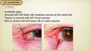 • Invariably gaps
• Sutured with 6/0 black silk mattress sutures at the white line
• Tarsus is sutured with 6/0 Vicryl sutures
• Skin is closed with 6/0 black silk or nylon sutures
Lid Margin
 