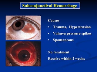 Causes Trauma,  Hypertension Valsava pressure spikes Spontaneous No treatment Resolve within 2 weeks Subconjunctival Hemorrhage 