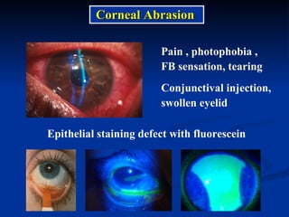 Pain , photophobia ,  FB sensation, tearing Conjunctival injection,  swollen eyelid Corneal Abrasion Epithelial staining defect with fluorescein   