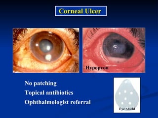 Corneal Ulcer Hypopyon Eye Shield No patching Topical antibiotics Ophthalmologist referral 