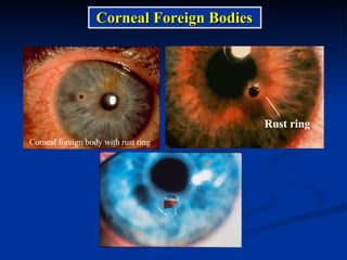 Corneal foreign body with rust ring Rust ring Corneal Foreign Bodies 
