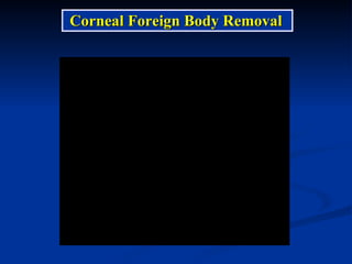 Corneal Foreign Body Removal 