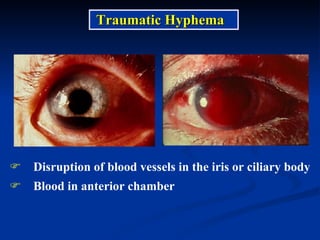 Disruption of blood vessels in the iris or ciliary body Blood in anterior chamber Traumatic Hyphema 