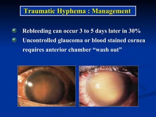 Rebleeding can occur 3 to 5 days later in 30% Uncontrolled glaucoma or blood stained cornea  requires anterior chamber “wash out”  Traumatic Hyphema : Management 