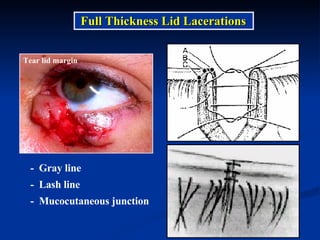 Full Thickness Lid Lacerations -  Gray line -  Lash line -  Mucocutaneous junction Tear lid margin 