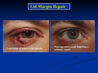 Laceration of lower eyelid margin Post-operative result following a primary repair Lid Margin Repair 