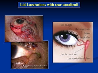 Lid Lacerations   with tear canaliculi 