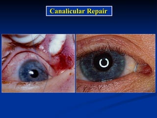 Canalicular Repair 