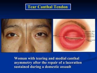 Woman with tearing and medial canthal asymmetry after the repair of a laceration sustained during a domestic assault Tear Canthal Tendon 