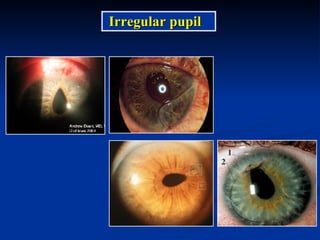 Irregular pupil 