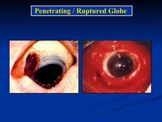 Penetrating / Ruptured Globe  