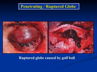 Ruptured globe caused by golf ball Penetrating / Ruptured Globe  