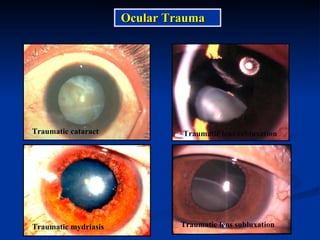 Ocular Trauma Traumatic cataract Traumatic mydriasis Traumatic lens subluxation Traumatic lens subluxation 