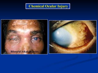 Bilateral Alkali Injuries Chemical Ocular Injury  