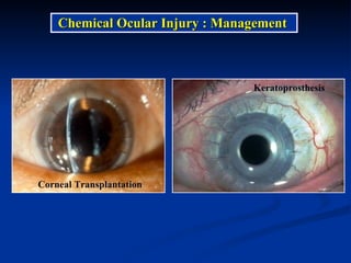 Chemical Ocular Injury : Management  Corneal Transplantation Keratoprosthesis 