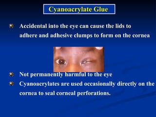 Accidental into the eye can cause the lids to  adhere and adhesive clumps to form on the cornea Not permanently harmful to the eye Cyanoacrylates are used occasionally directly on the  cornea to seal corneal perforations.  Cyanoacrylate Glue 